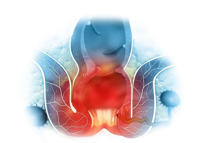 Proctonic krem ​​ile iç ve dış hemoroidlerin etkili tedavisi